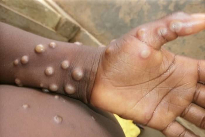 Mpox não é nova covid, diz diretor da OMS na Europa