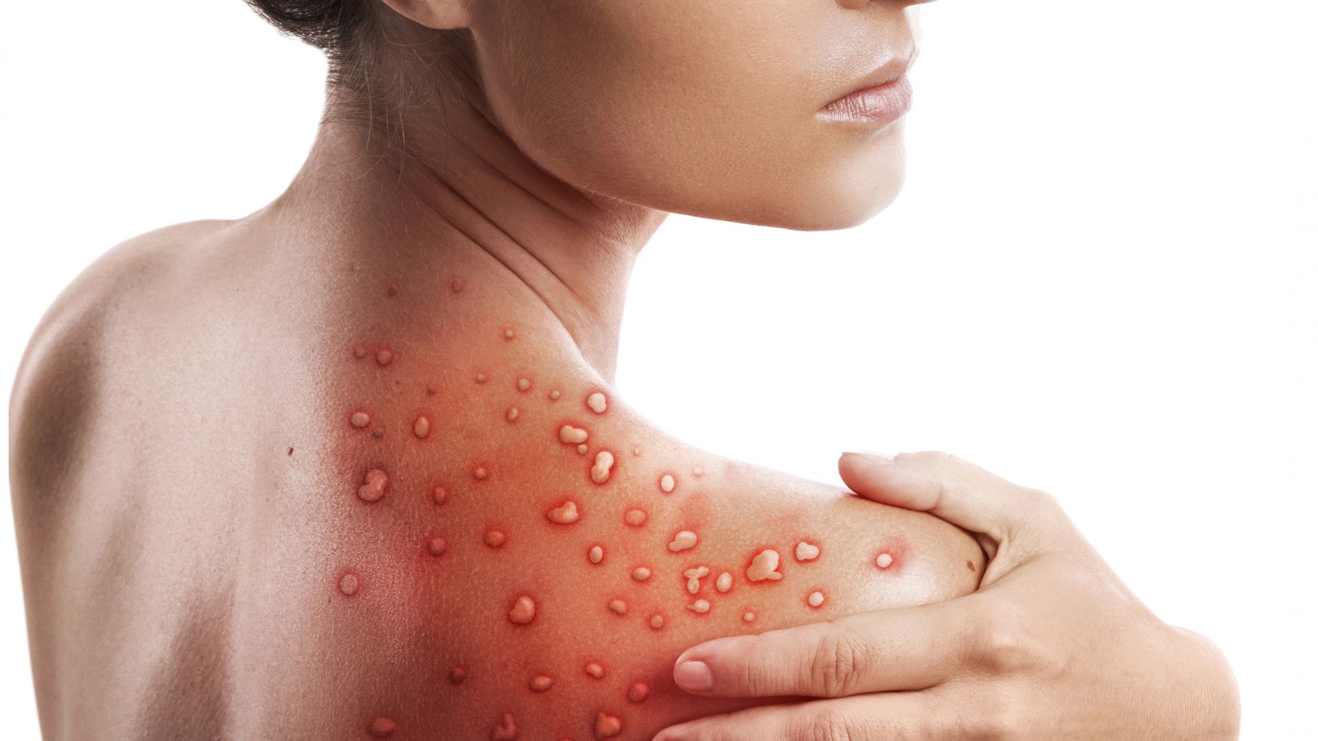 Nova cepa de Mpox faz sua primeira vítima no Brasil