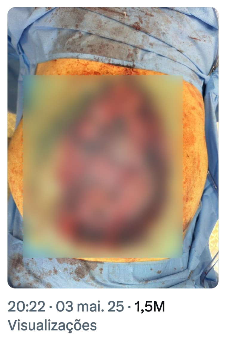 Bolsonaro posta foto de sua barriga aberta, mostrando o intestino